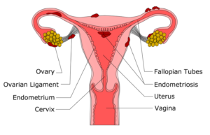 Scientific illustration of how endometriosis looks like