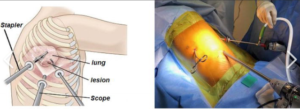 A thoracoscopy procedure